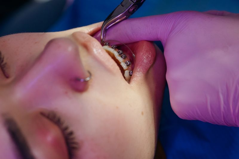 Braces & Aligners