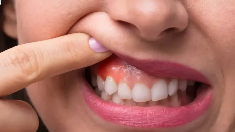 Swollen Gums? Here’s What It Means and How to Treat It